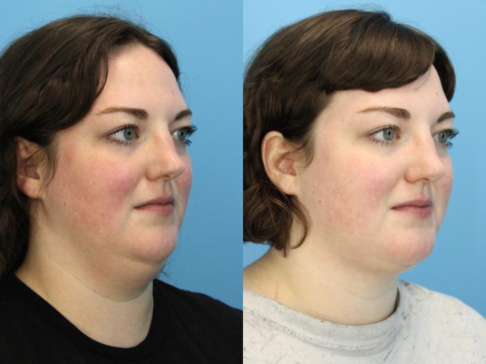 Before & After Facial Liposuction Case 589 Left Oblique View in West Des Moines & Ames, IA