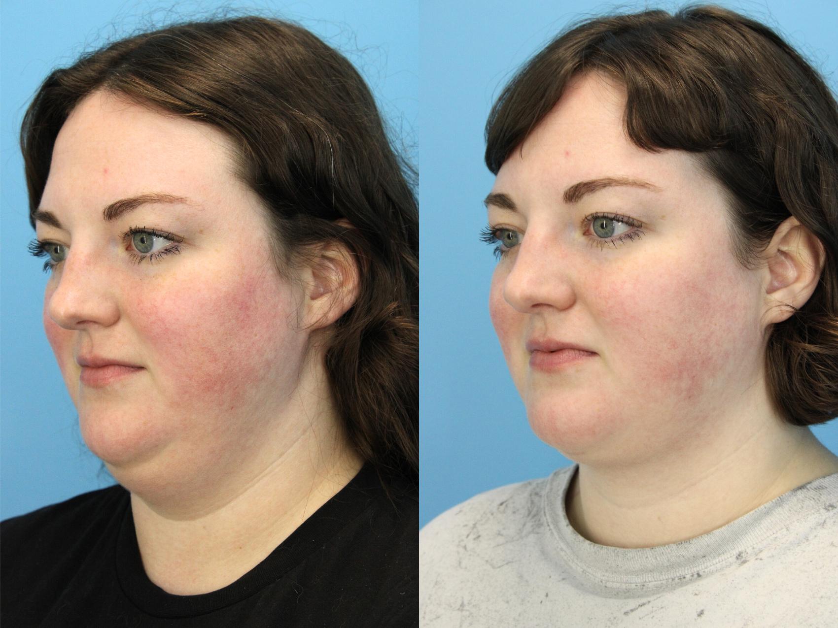 Before & After Facial Liposuction Case 589 Right Oblique View in West Des Moines & Ames, IA