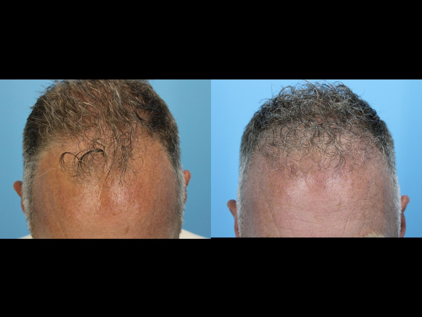 Before & After Hair Restoration Case 639 Down View in West Des Moines & Ames, IA