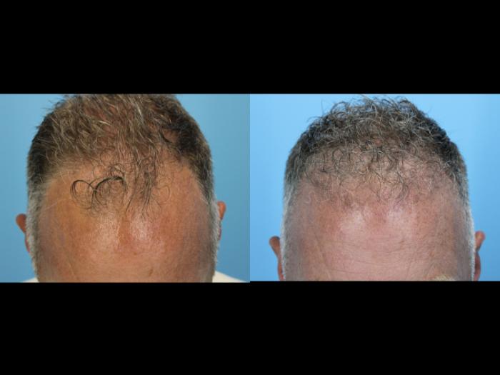 Before & After Hair Restoration Case 639 Down View in West Des Moines & Ames, IA