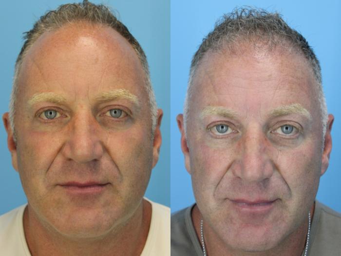Before & After Hair Restoration Case 639 Front View in West Des Moines & Ames, IA