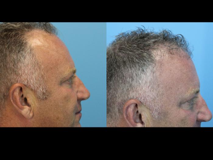 Before & After Hair Restoration Case 639 Left Side View in West Des Moines & Ames, IA