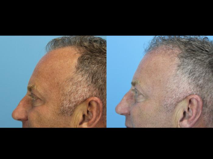 Before & After Hair Restoration Case 639 Right Side View in West Des Moines & Ames, IA
