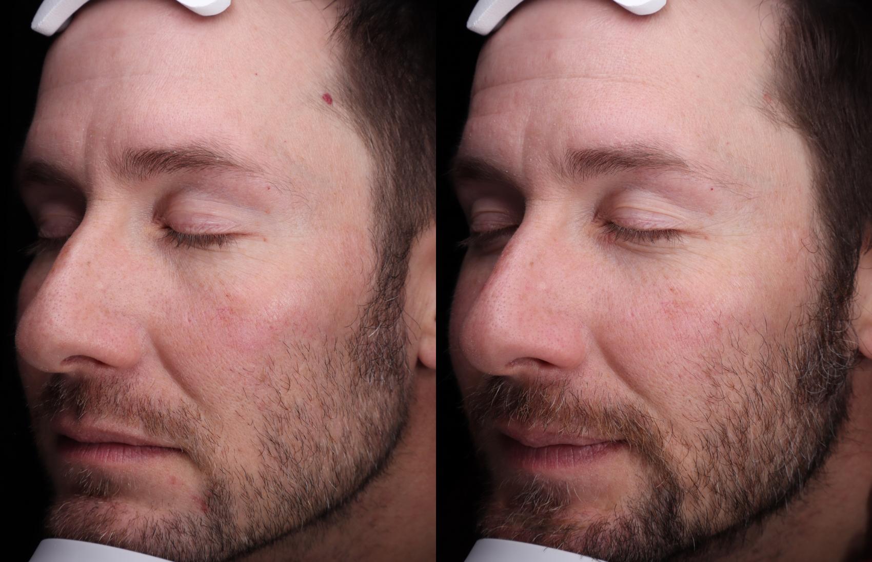 Before & After Laser Resurfacing Treatments Case 510 Left Side View in West Des Moines & Ames, IA