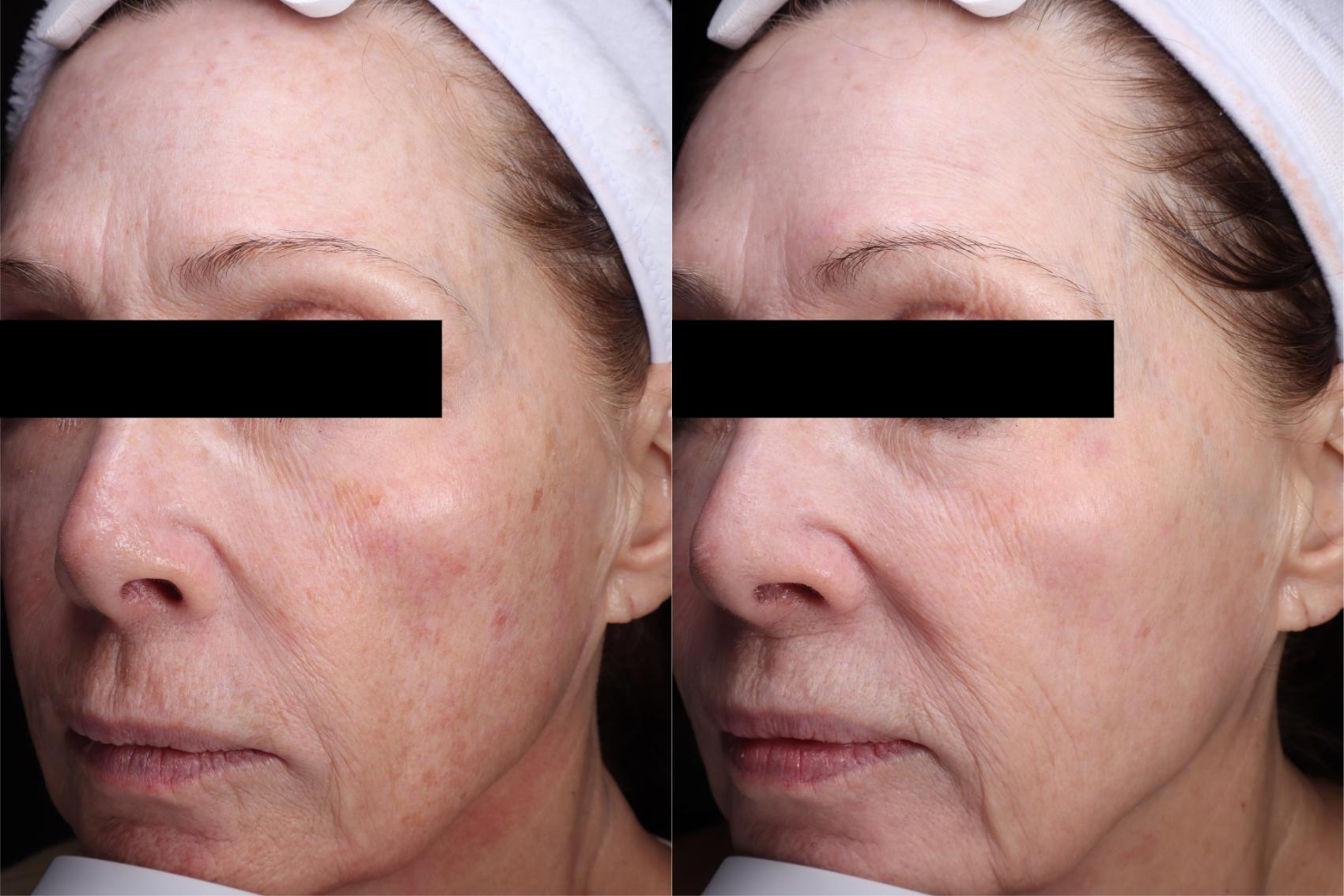 Before & After Laser Resurfacing Treatments Case 511 Left Side View in West Des Moines & Ames, IA