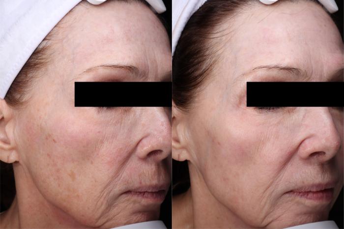 Before & After Laser Resurfacing Treatments Case 511 Right Side View in West Des Moines & Ames, IA