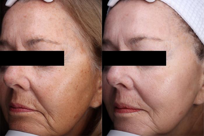 Before & After Laser Resurfacing Treatments Case 512 Left Side View in West Des Moines & Ames, IA