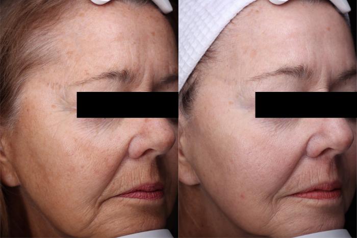 Before & After Laser Resurfacing Treatments Case 512 Right Side View in West Des Moines & Ames, IA