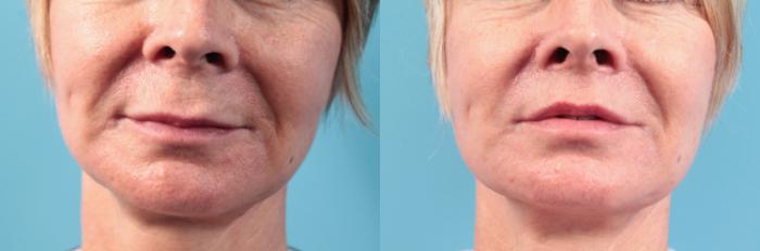 Before & After Lip Augmentation (Lift) Case 94 View #1 View in West Des Moines & Ames, IA