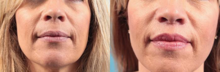 Before & After Lip Augmentation (Lift) Case 95 View #1 View in West Des Moines & Ames, IA