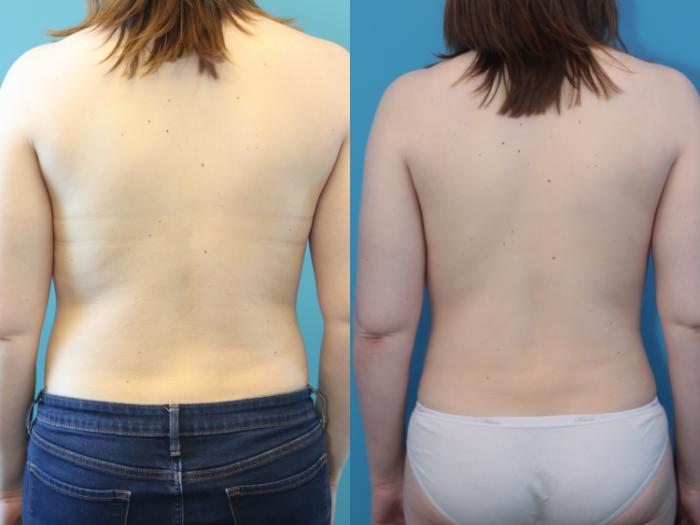 Before & After Liposuction/ Fat Transfer/ Brazilian Butt Lift Case 316 Back View in West Des Moines & Ames, IA
