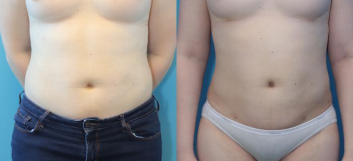 Before & After Liposuction/ Fat Transfer/ Brazilian Butt Lift Case 316 Front View in West Des Moines, IA