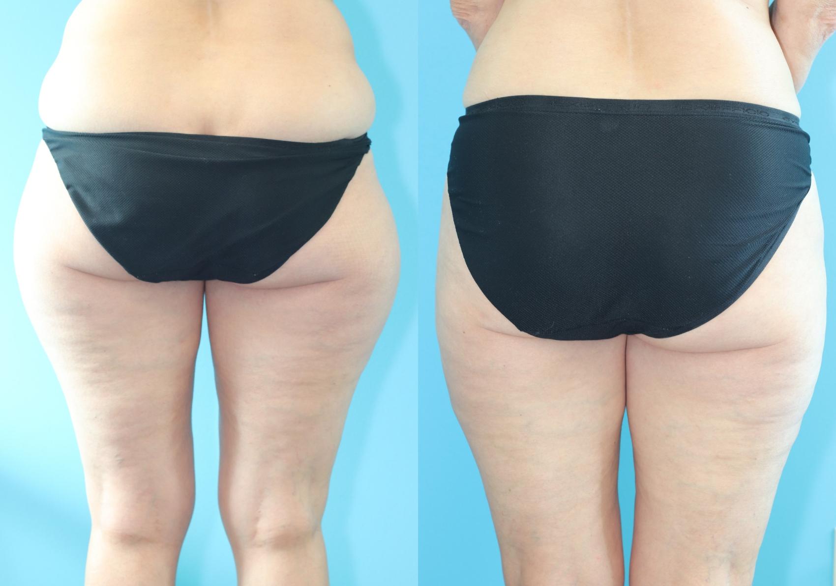 Before & After Liposuction/ Fat Transfer/ Brazilian Butt Lift Case 317 Back View in West Des Moines, IA