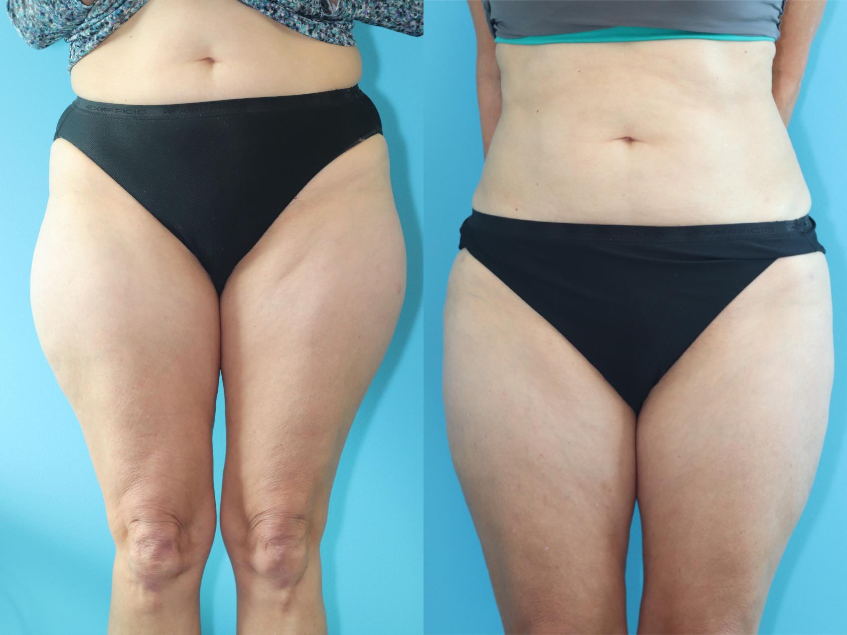 Before & After Liposuction/ Fat Transfer/ Brazilian Butt Lift Case 317 Front View in West Des Moines & Ames, IA