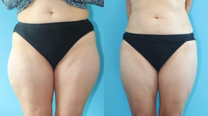 Before & After Liposuction/ Fat Transfer/ Brazilian Butt Lift Case 317 Front View in West Des Moines & Ames, IA