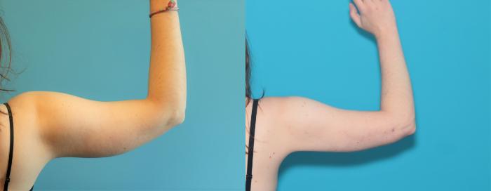 Before & After Liposuction/ Fat Transfer/ Brazilian Butt Lift Case 318 Back View in West Des Moines & Ames, IA