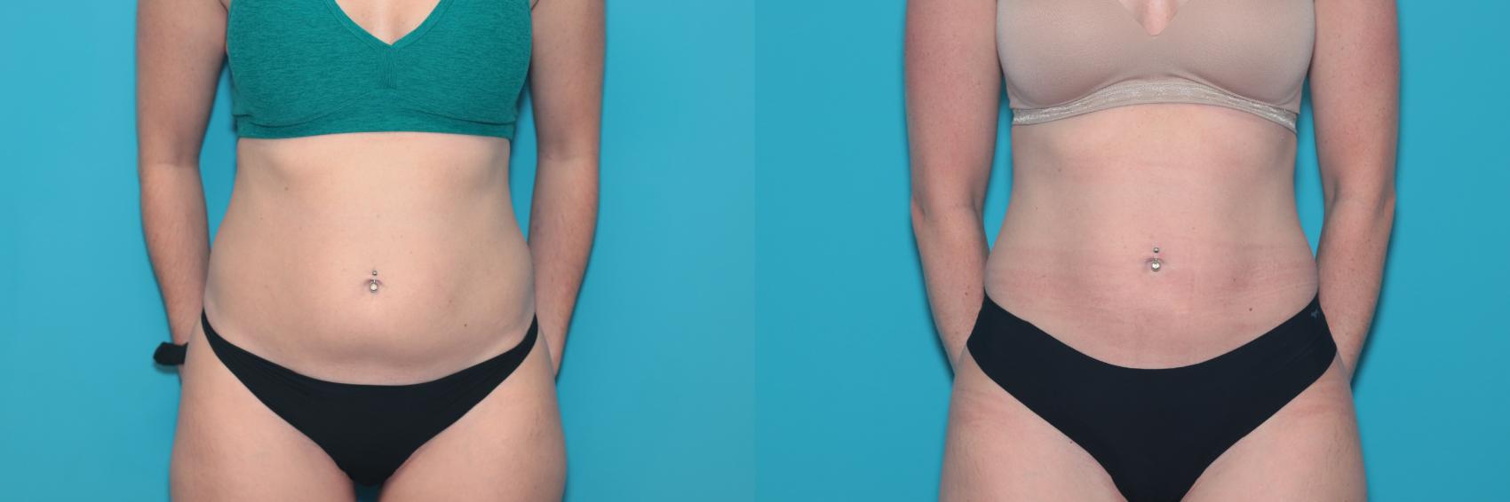 Before & After Liposuction/ Fat Transfer/ Brazilian Butt Lift Case 336 Front View in West Des Moines & Ames, IA