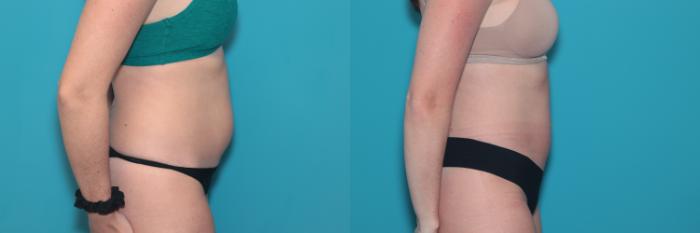 Before & After Liposuction/ Fat Transfer/ Brazilian Butt Lift Case 336 Right Side View in West Des Moines & Ames, IA