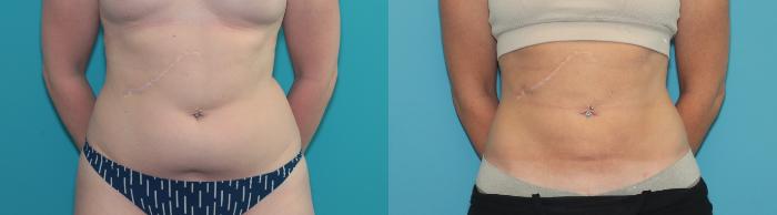 Before & After Liposuction/ Fat Transfer/ Brazilian Butt Lift Case 373 Front View in West Des Moines & Ames, IA