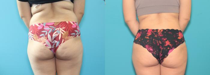 Before & After Liposuction/ Fat Transfer/ Brazilian Butt Lift Case 389 Back View in West Des Moines & Ames, IA