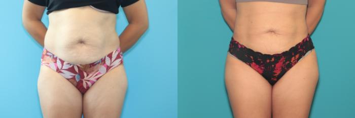 Before & After Liposuction/ Fat Transfer/ Brazilian Butt Lift Case 389 Front View in West Des Moines & Ames, IA