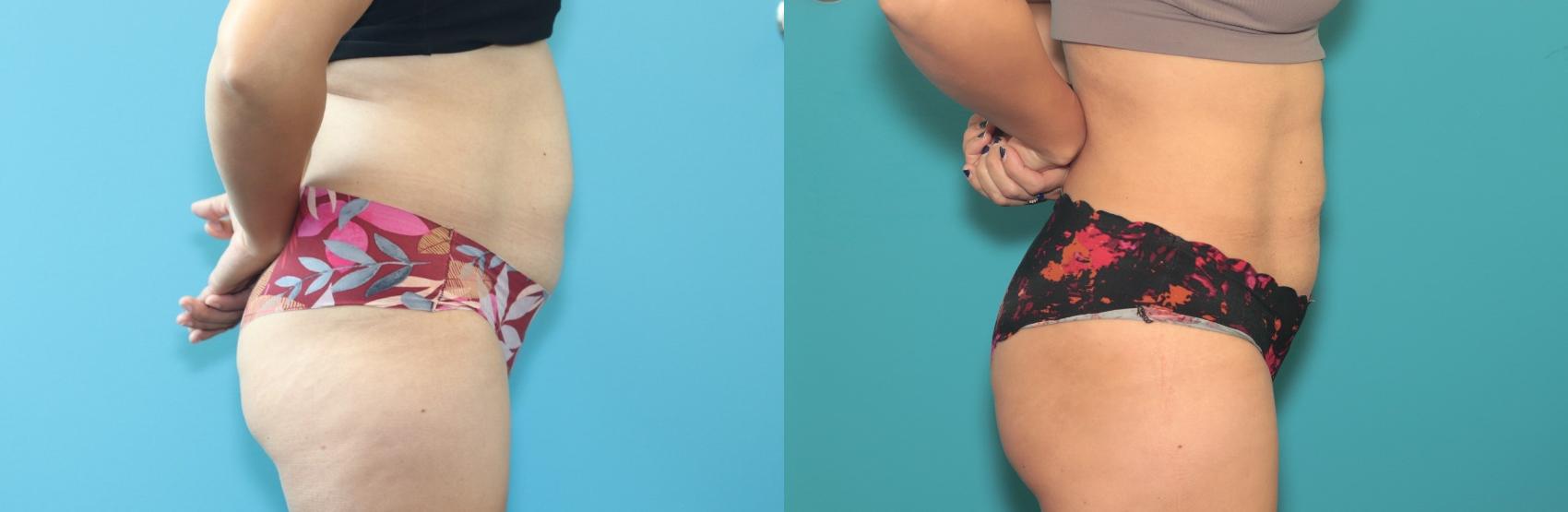 Before & After Liposuction/ Fat Transfer/ Brazilian Butt Lift Case 389 Right Side View in West Des Moines & Ames, IA