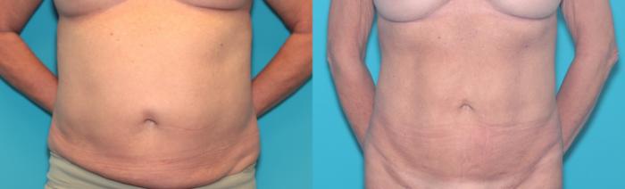 Before & After Liposuction/ Fat Transfer/ Brazilian Butt Lift Case 409 Liposuction: front View in West Des Moines & Ames, IA