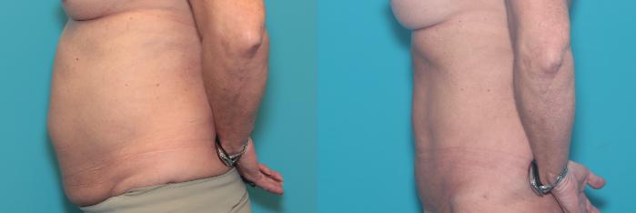 Before & After Liposuction/ Fat Transfer/ Brazilian Butt Lift Case 409 Right Side View in West Des Moines & Ames, IA