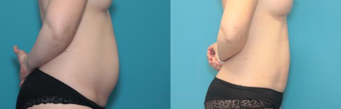 Before & After Liposuction/ Fat Transfer/ Brazilian Butt Lift Case 436 Right Side View in West Des Moines & Ames, IA