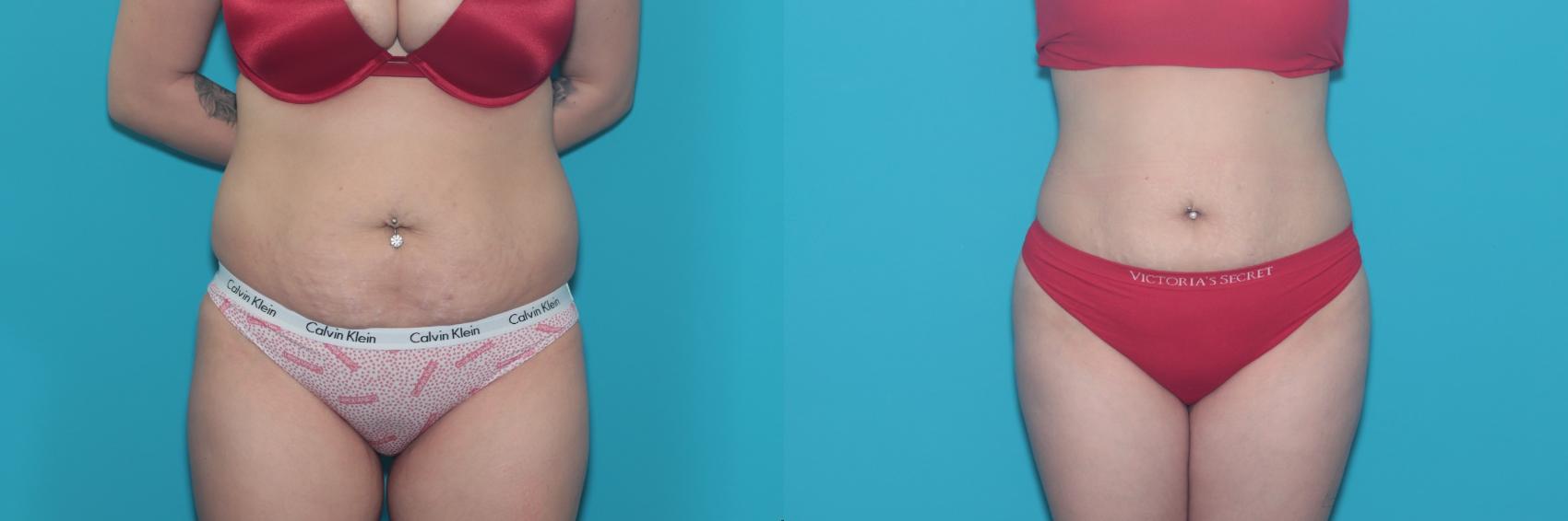 Before & After Liposuction/ Fat Transfer/ Brazilian Butt Lift Case 466 Front View in West Des Moines & Ames, IA