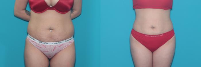 Before & After Liposuction/ Fat Transfer/ Brazilian Butt Lift Case 466 Front View in West Des Moines & Ames, IA