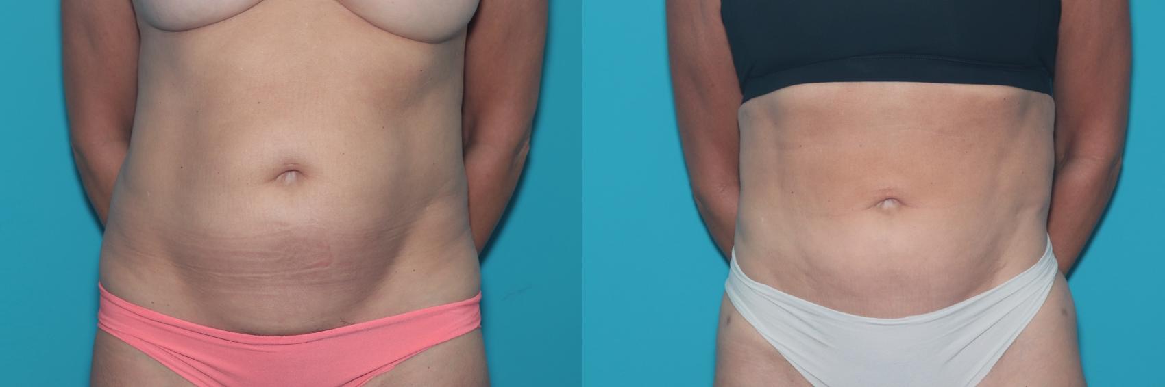 Before & After Liposuction/ Fat Transfer/ Brazilian Butt Lift Case 468 Front View in West Des Moines & Ames, IA