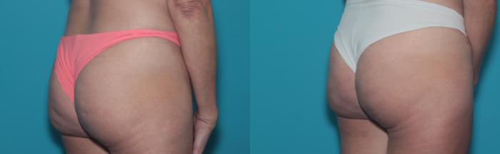 Before & After Liposuction/ Fat Transfer/ Brazilian Butt Lift Case 468 Right Oblique View in West Des Moines & Ames, IA