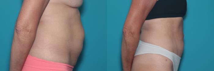 Before & After Liposuction/ Fat Transfer/ Brazilian Butt Lift Case 468 Right Side View in West Des Moines & Ames, IA