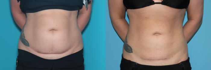 Before & After Liposuction/ Fat Transfer/ Brazilian Butt Lift Case 524 Front View in West Des Moines & Ames, IA