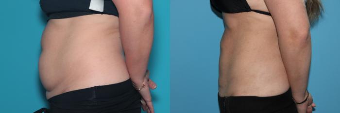 Before & After Liposuction/ Fat Transfer/ Brazilian Butt Lift Case 524 Left Side View in West Des Moines & Ames, IA
