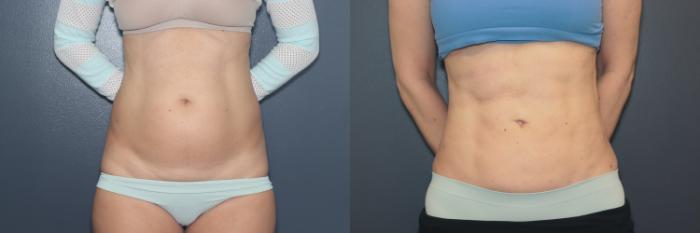 Before & After Liposuction/ Fat Transfer/ Brazilian Butt Lift Case 592 Front View in West Des Moines & Ames, IA