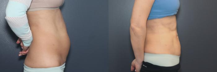 Before & After Liposuction/ Fat Transfer/ Brazilian Butt Lift Case 592 Right Side View in West Des Moines & Ames, IA