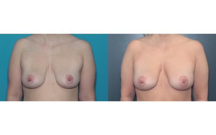 Before & After Liposuction/ Fat Transfer/ Brazilian Butt Lift Case 657 Fat Transfer - Front View in West Des Moines & Ames, IA