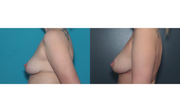 Before & After Liposuction/ Fat Transfer/ Brazilian Butt Lift Case 657 Fat Transfer - Right  View in West Des Moines & Ames, IA