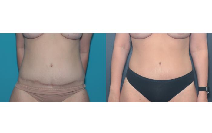 Before & After Liposuction/ Fat Transfer/ Brazilian Butt Lift Case 657 Front View in West Des Moines & Ames, IA