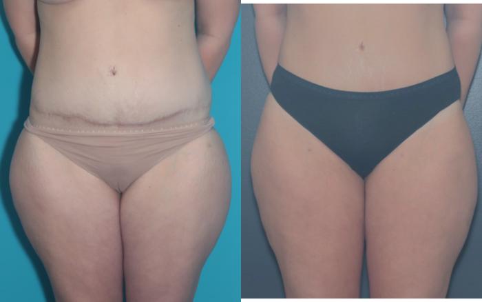 Before & After Liposuction/ Fat Transfer/ Brazilian Butt Lift Case 657 Front2 View in West Des Moines & Ames, IA