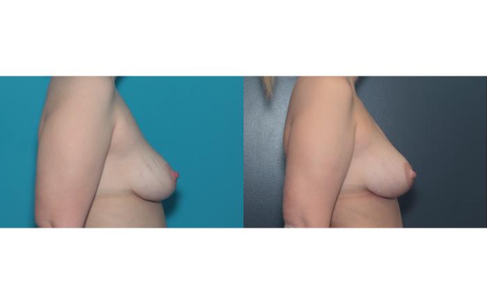 Before & After Liposuction/ Fat Transfer/ Brazilian Butt Lift Case 657 Left Side View in West Des Moines & Ames, IA