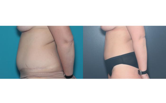 Before & After Liposuction/ Fat Transfer/ Brazilian Butt Lift Case 657 Right Side View in West Des Moines & Ames, IA