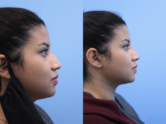 Before & After Non-Surgical Rhinoplasty Case 161 View #1 View in West Des Moines & Ames, IA