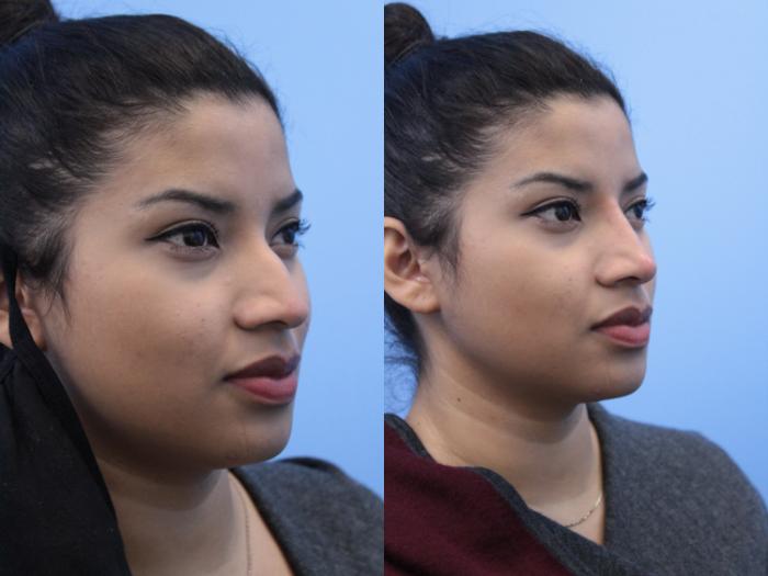 Before & After Non-Surgical Rhinoplasty Case 161 View #2 View in West Des Moines & Ames, IA