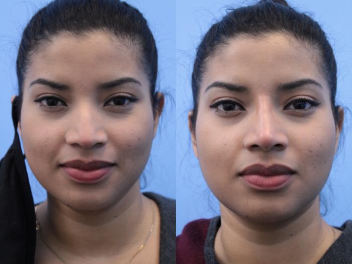 Before & After Non-Surgical Rhinoplasty Case 161 View #3 View in West Des Moines & Ames, IA