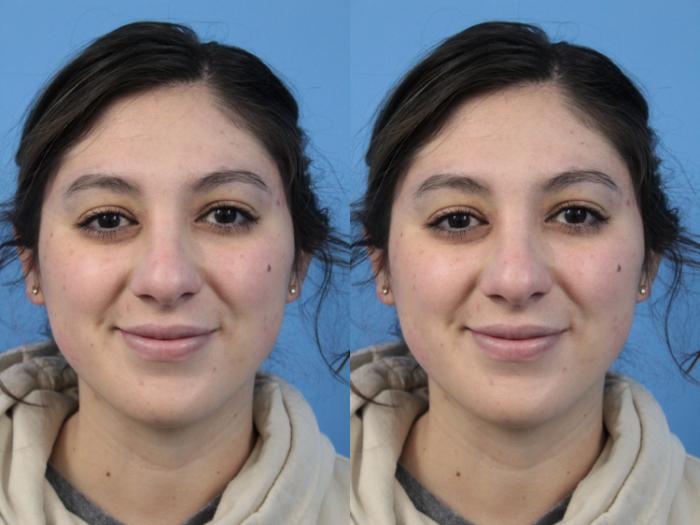 Before & After Non-Surgical Rhinoplasty Case 169 View #1 View in West Des Moines & Ames, IA