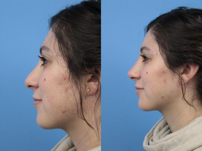 Before & After Non-Surgical Rhinoplasty Case 169 View #2 View in West Des Moines & Ames, IA