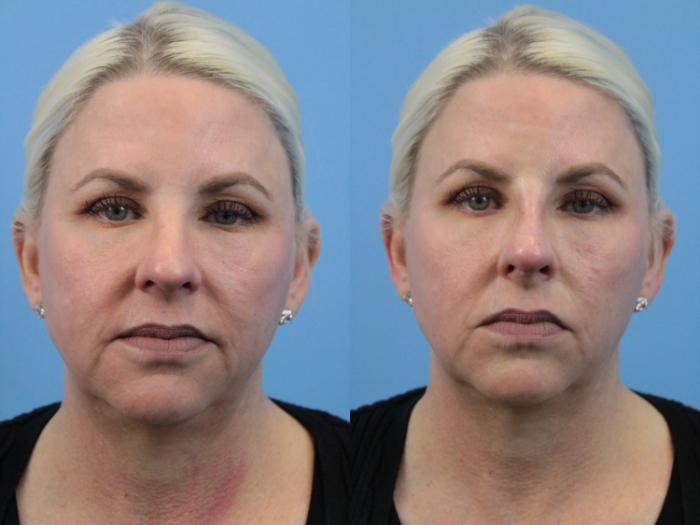 Before & After Non-Surgical Rhinoplasty Case 181 View #1 View in West Des Moines & Ames, IA